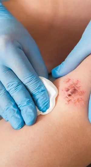 Wound Dressing